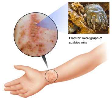 What you need to know about scabies